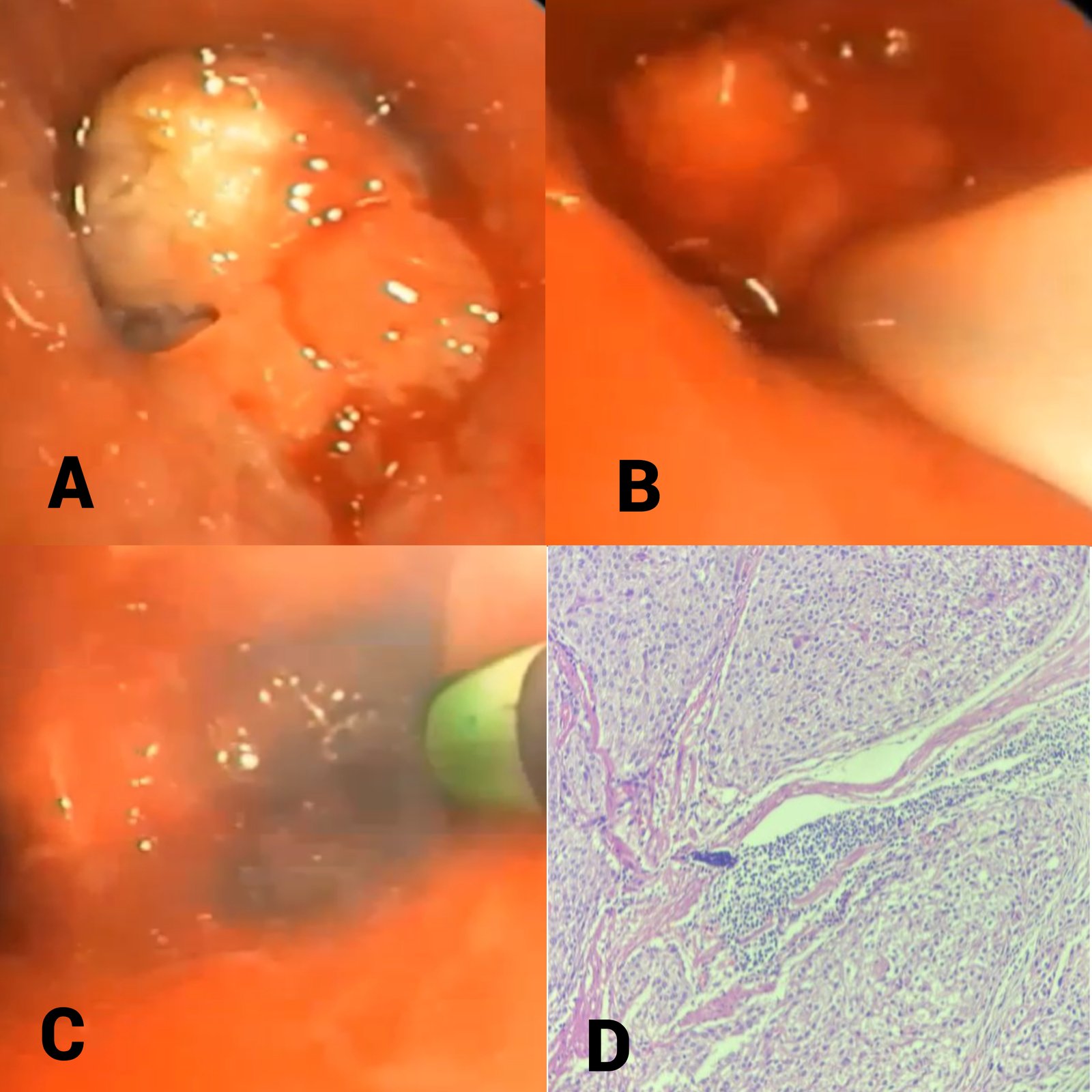 Endobronchial carcinoid tumor 