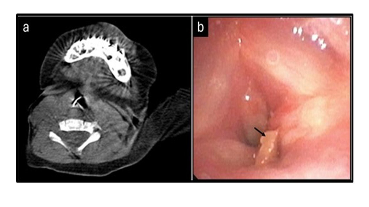 Chest CT showing a radio-opaque foreign body in the subglottic region, and flexible bronchoscopy view of the object below the vocal cords