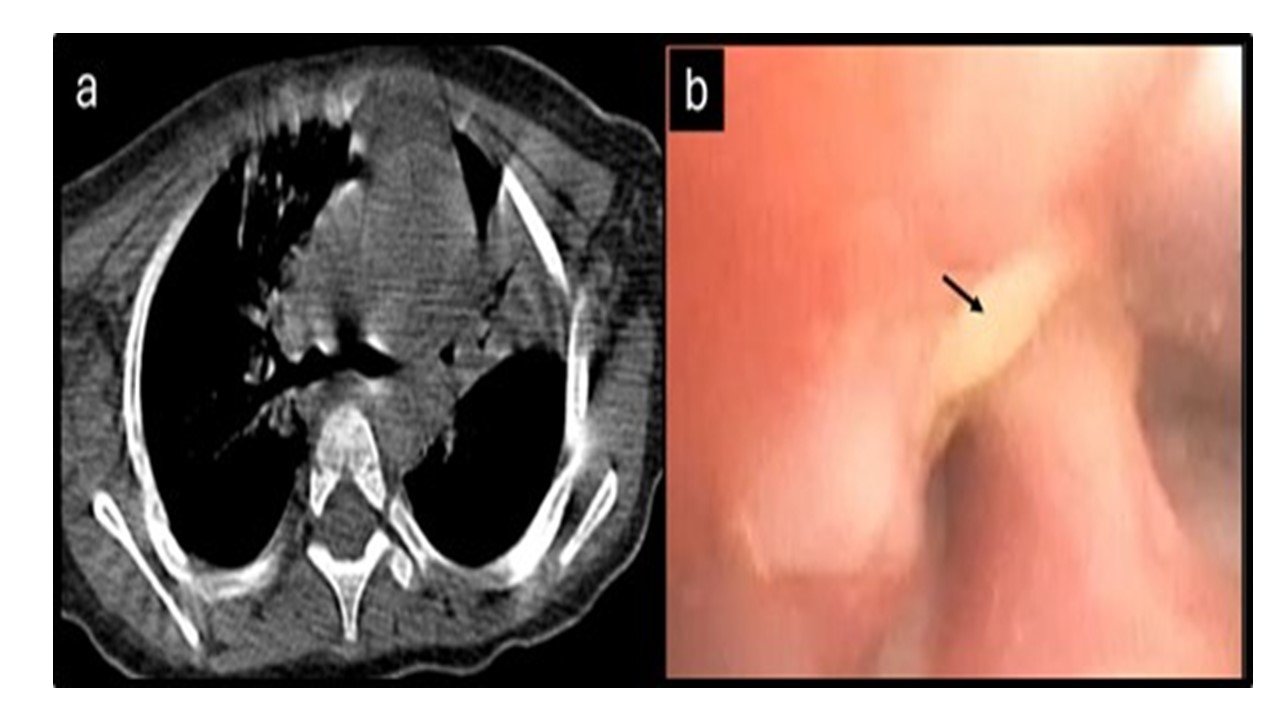 CT chest showing a foreign body in the right bronchus intermedius and flexible bronchoscopy confirming the foreign body at the same site