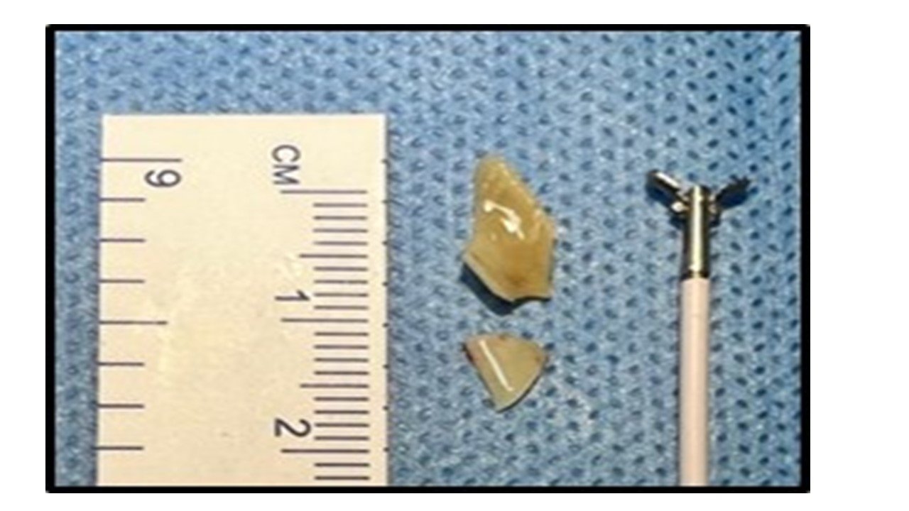 Extracted foreign body (chicken bone) in two pieces.
