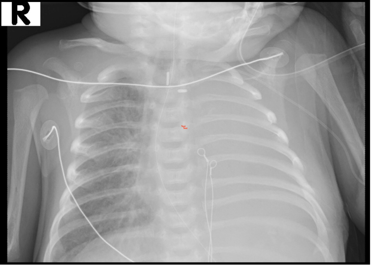 Chest radiograph prior to procedure