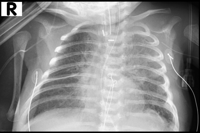 Chest radiograph following procedure