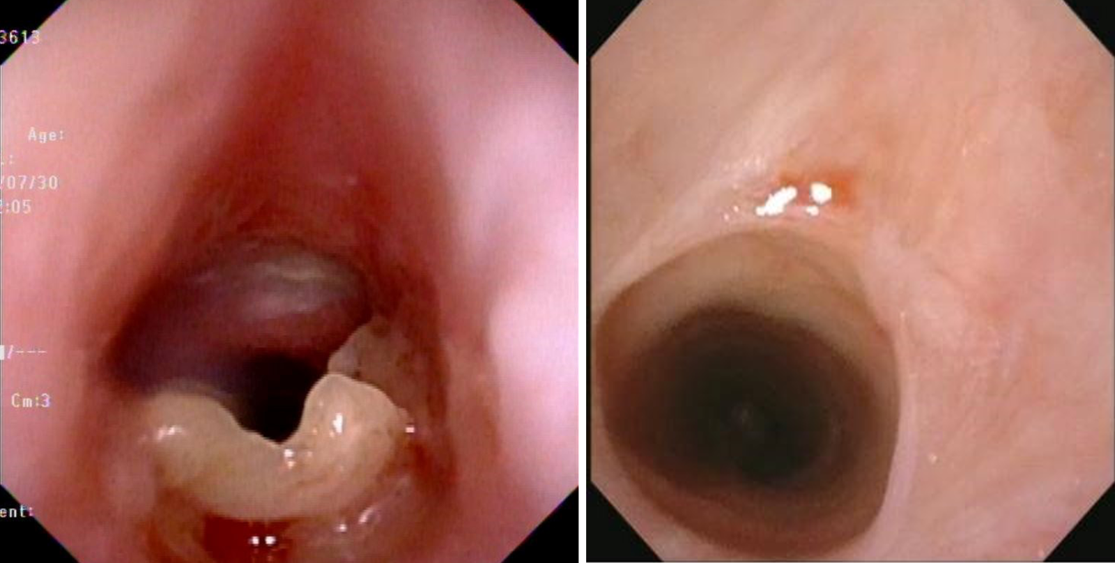 Bronchoscopic view showing the subglottic stenosis before and after laser ablation