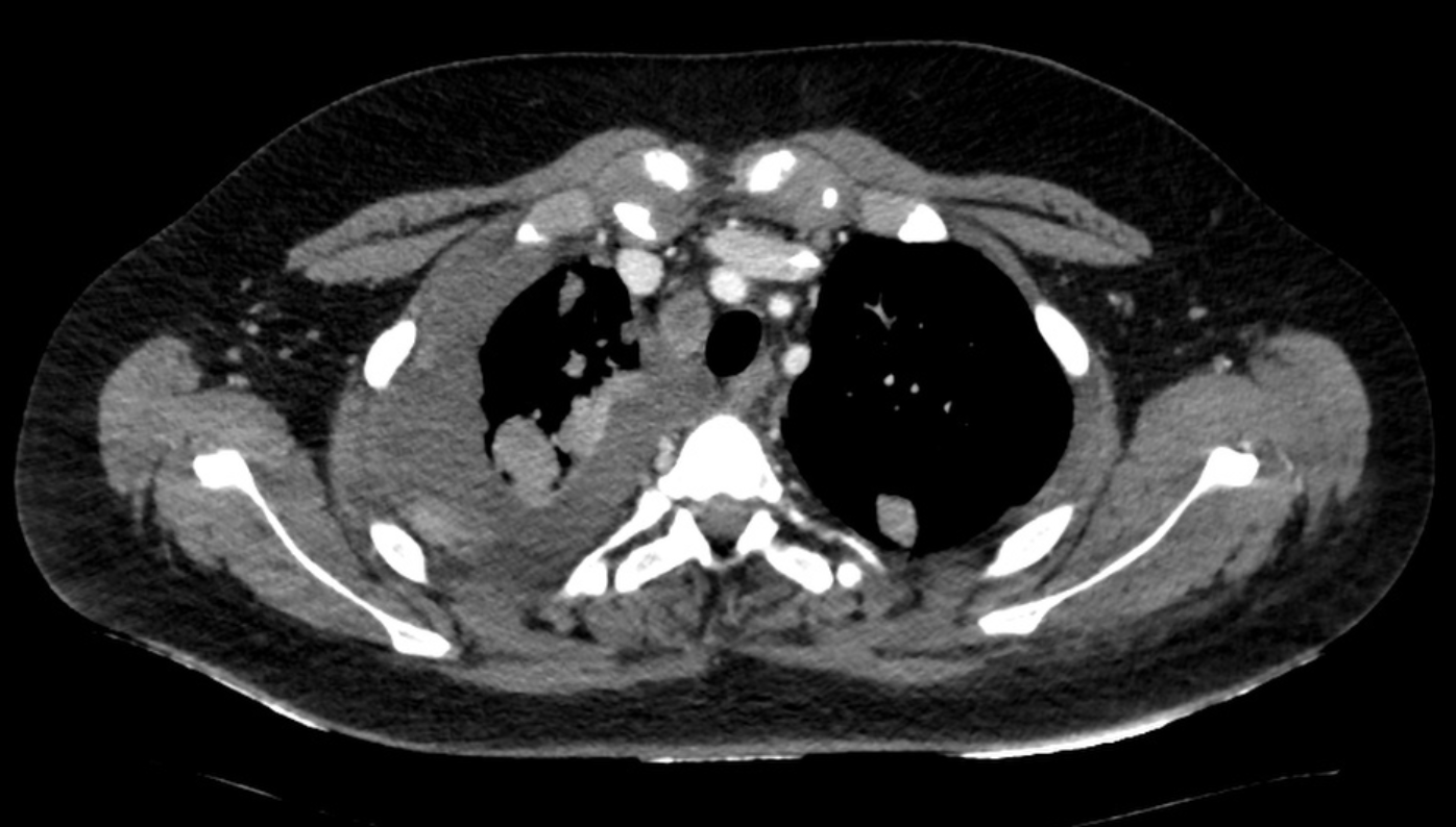 Initial chest CT findings: Massive right sided pleural effusion can be seen, along with multiple metastatic nodules affecting the lung parenchyma and parietal pleura