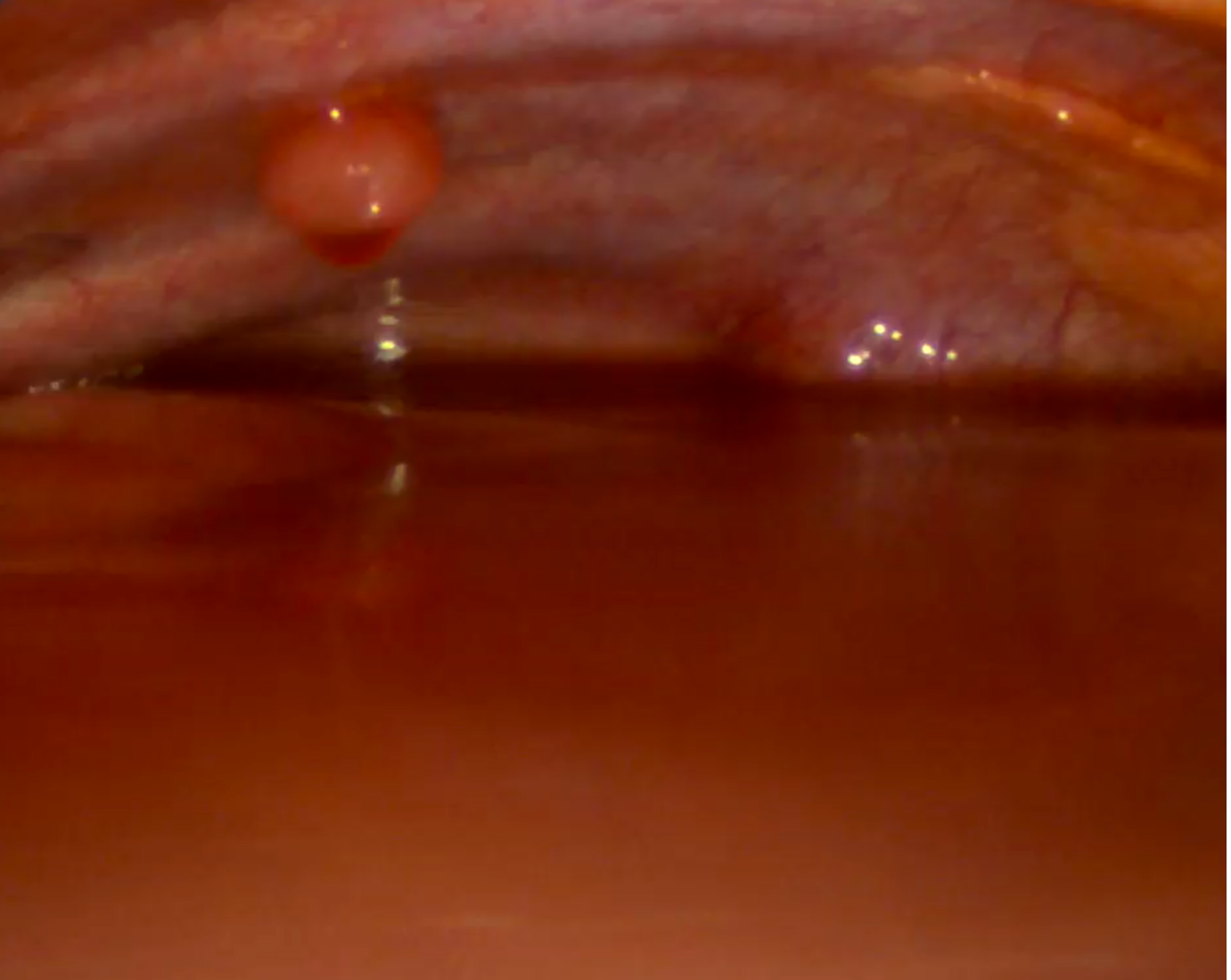 View of the pleural cavity upon thoracoscopic entry: Massive serosanguinous fluid filled the entire pleural cavity. A solitary pleural metastasis is observed.