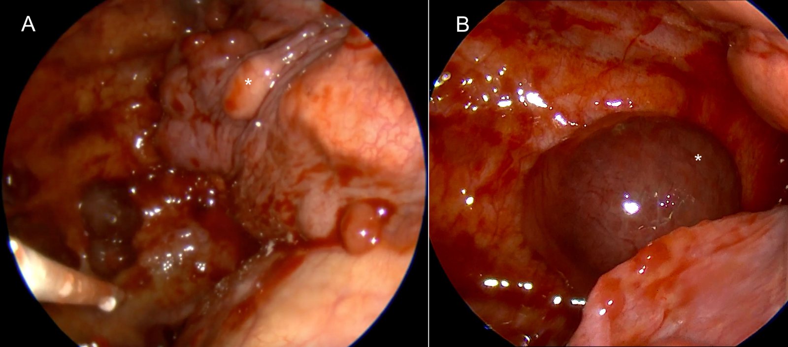 View of the pleural cavity after fluid aspiration: A - Multiple metastases (white asterisk) are can be seen on the lung surface. B - A close-up view of a large metastasis on the parietal pleura