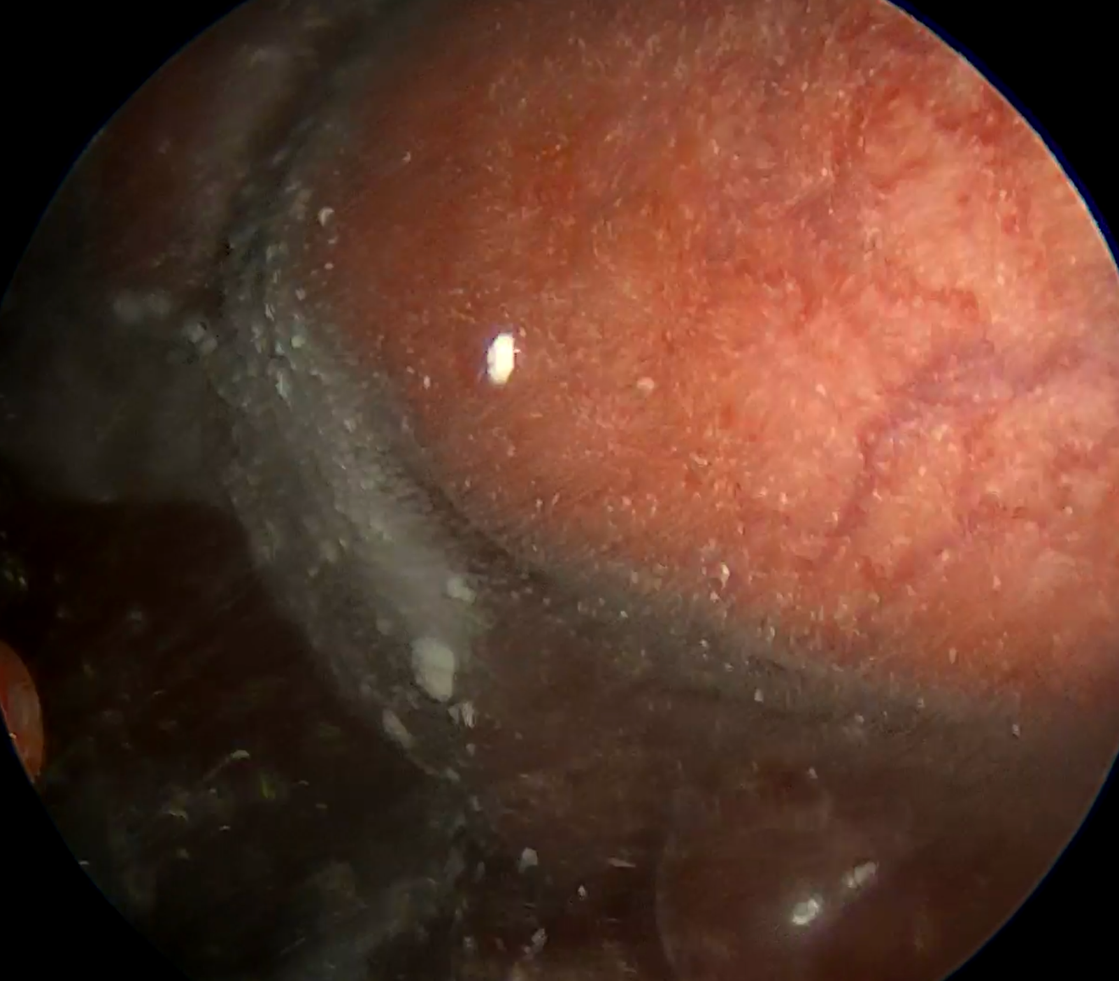 Pleural cavity after talc poudrage, with talk powder evenly distributed across the visceral and parietal pleura.