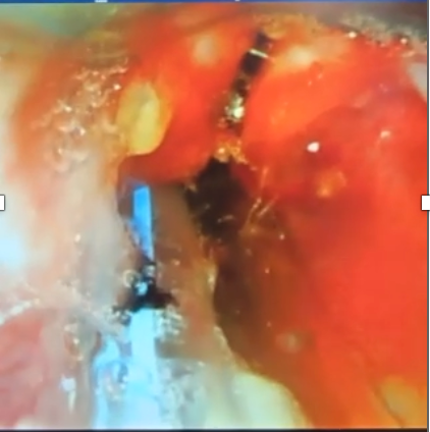 Video laryngoscopy showing slit-like deformity