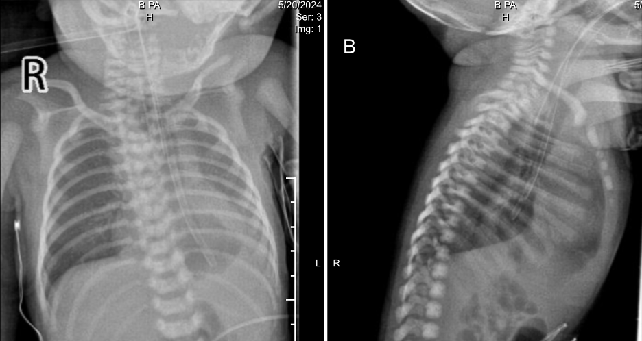 AP and lateral chest X-rays after intubation