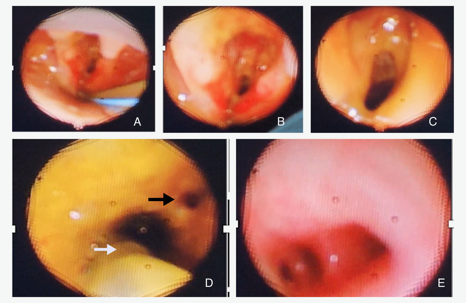 Bronchoscopic images collage