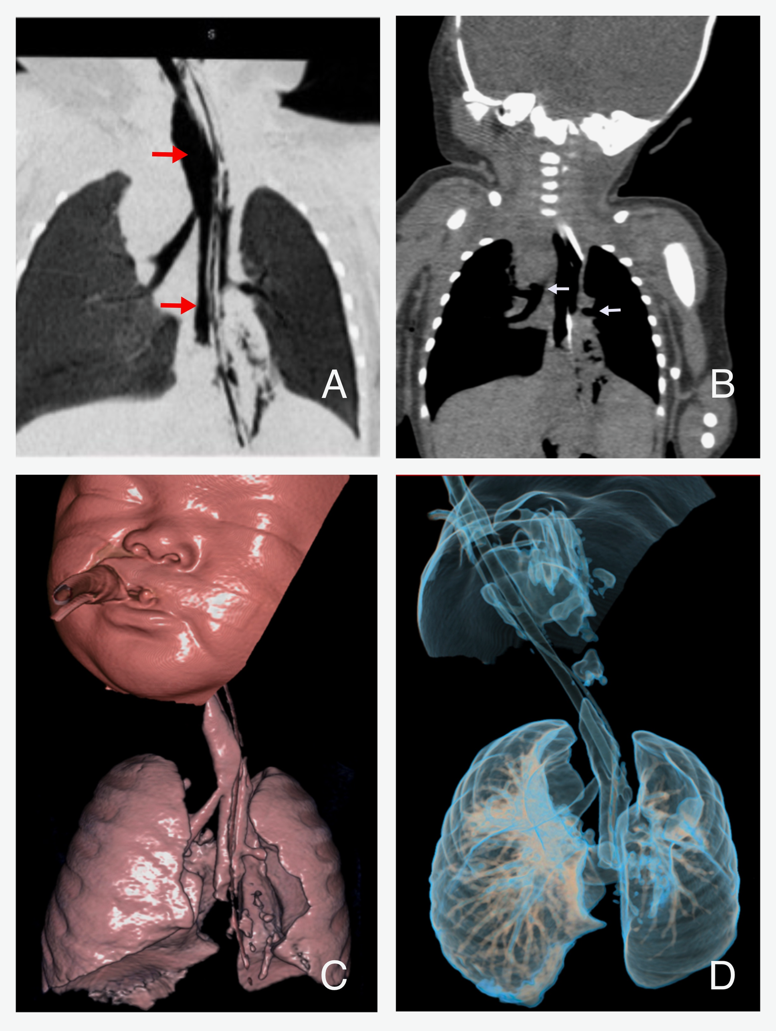 CT and 3D reconstructions of airway
