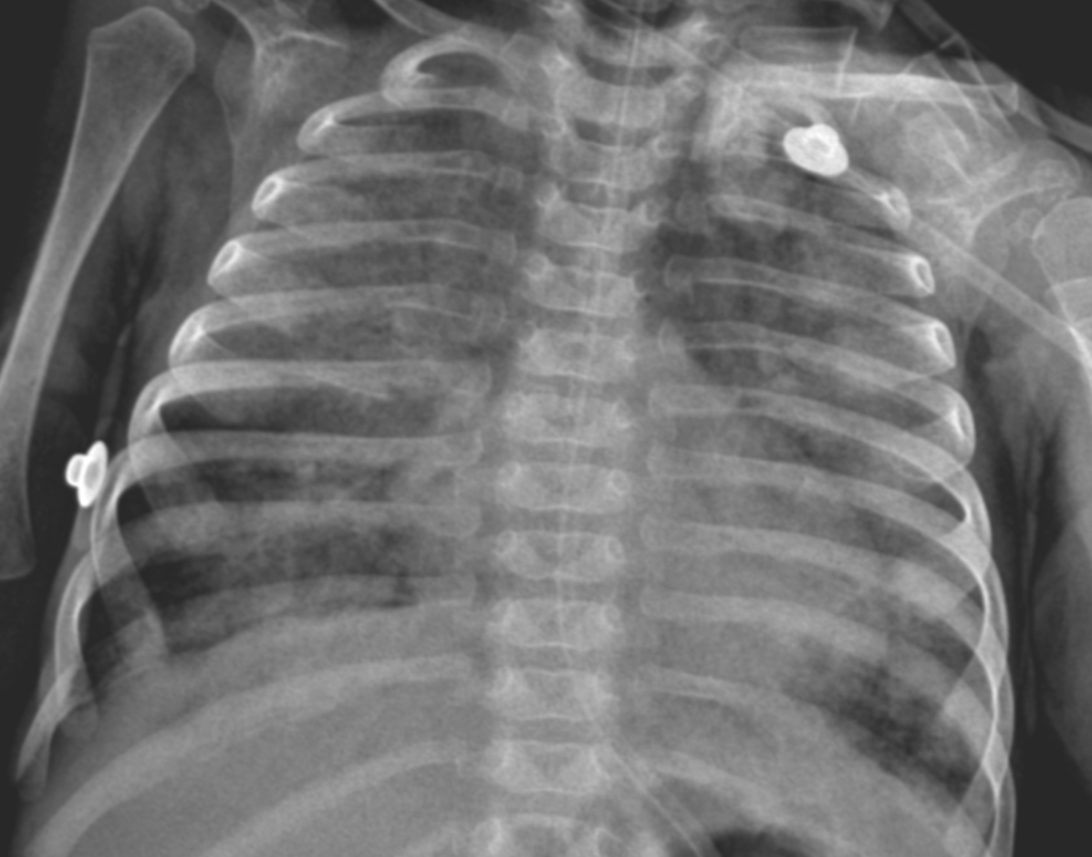 Post-extubation chest radiograph