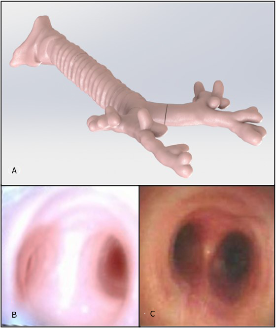 Computer rendering and bronchoscope views of the 3D printed pediatric airway