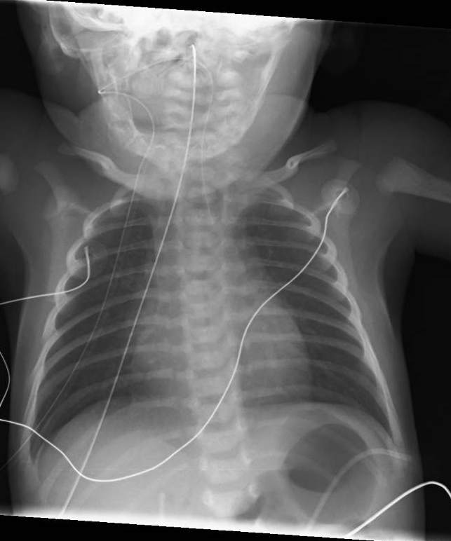 Chest x-ray on day 1 of life