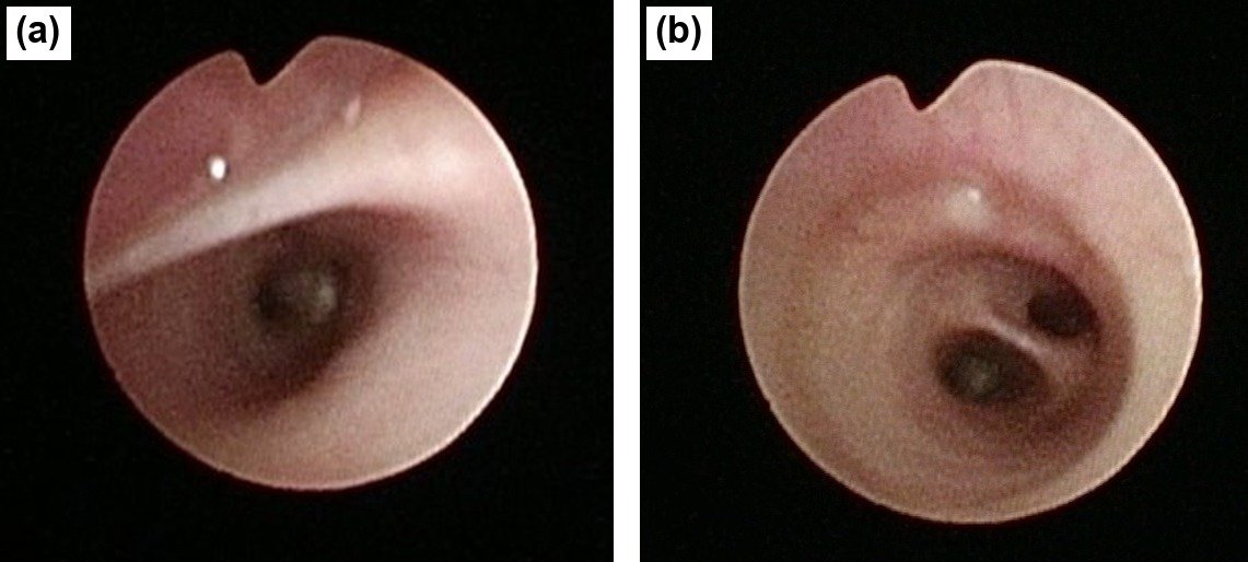Distal tracheoesophageal fistula, collapsed during spontaneous breathing and splinted open by positive airway pressure