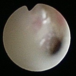 Proximal tracheoesophageal fistula opened by local insufflation with low-flow oxygen