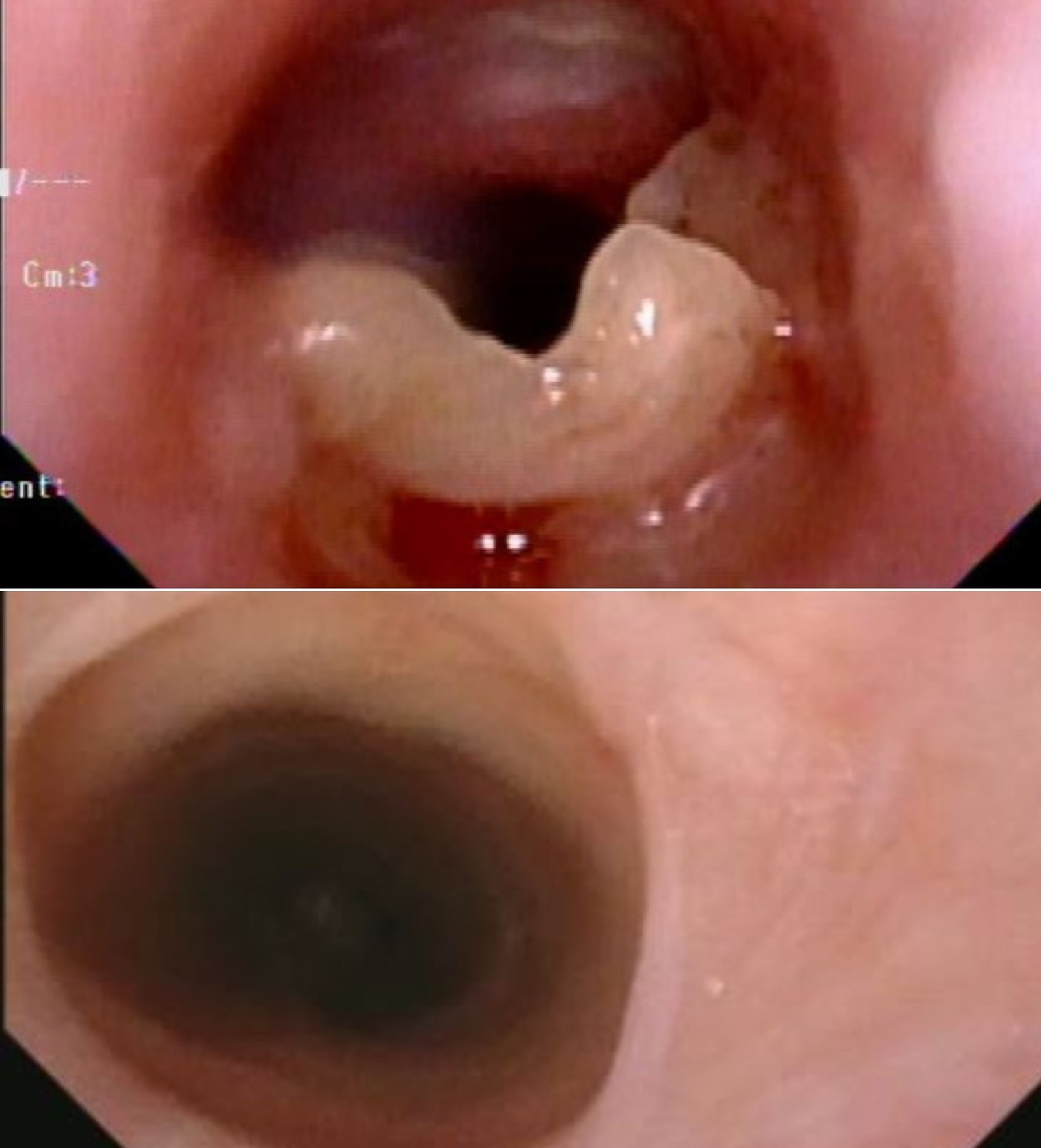 Bronchoscopic view showing the subglottic stenosis before (left) and after(right) laser ablation.