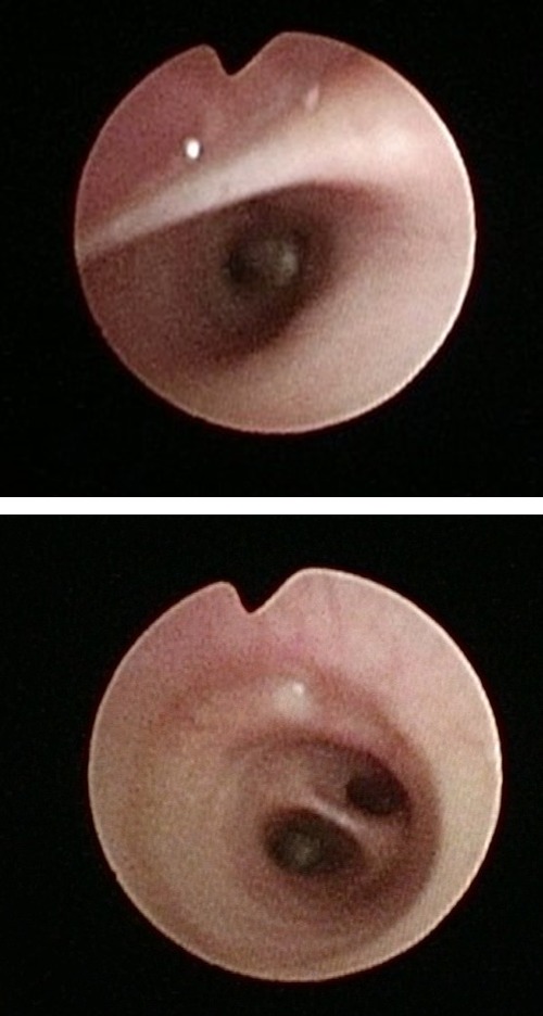Bronchoscopic views of the distal tracheoesophageal fistula. (a) Collapsed fistula during spontaneous breathing; the bronchoscope is rotated, with the posterior tracheal wall appearing in the upper portion of the image. (b) The same fistula, in the upper aspect of the image, splinted open by applied positive airway pressure.